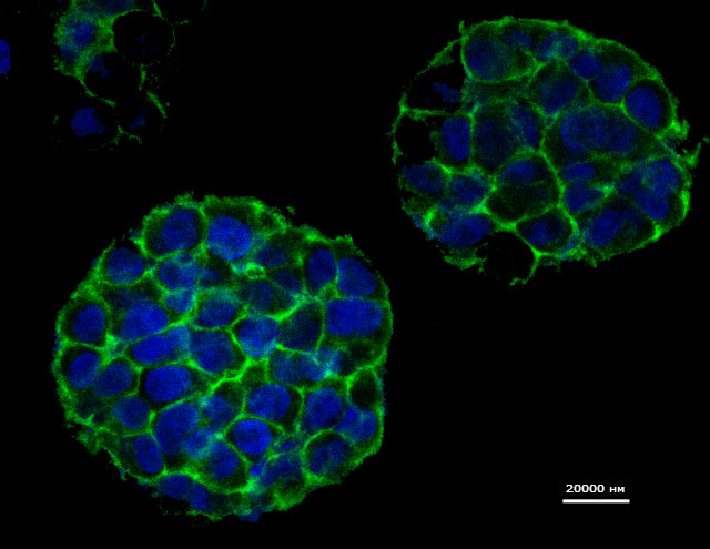 Реалистичная трёхмерная модель раковой опухоли была изготовлена с помощью 3D-принтера (фото Zhao et al., Biofabrication).