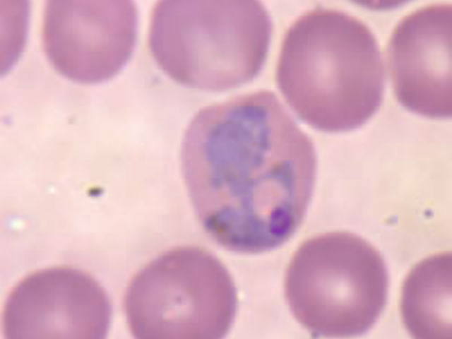 Эритроциты, заражённые паразитом-переносчиком малярии (фото Wikimedia Commons). 